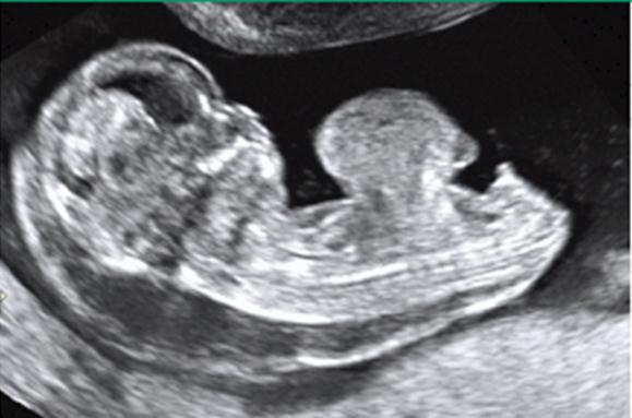 Figura 5 - Ultrassonografia fetal - onfalocele 11 Figura 6 - Ultrassonografia fetal - gastrosquise 11 Pós-natal O diagnóstico pós-natal é evidente através do exame do RN e ocorre ao se encontrar
