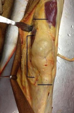 29 Figura 2 Imagem anterior de um joelho esquerdo após início da dissecção da pele e subcutâneo.