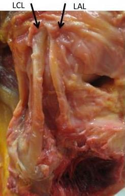 45 Figura 9 Figura de uma dissecção de um joelho direito mostrando a origem do ligamento anterolateral (LAL), anterodistal à origem do ligamento colateral lateral (LCL) Após sua origem femoral, o