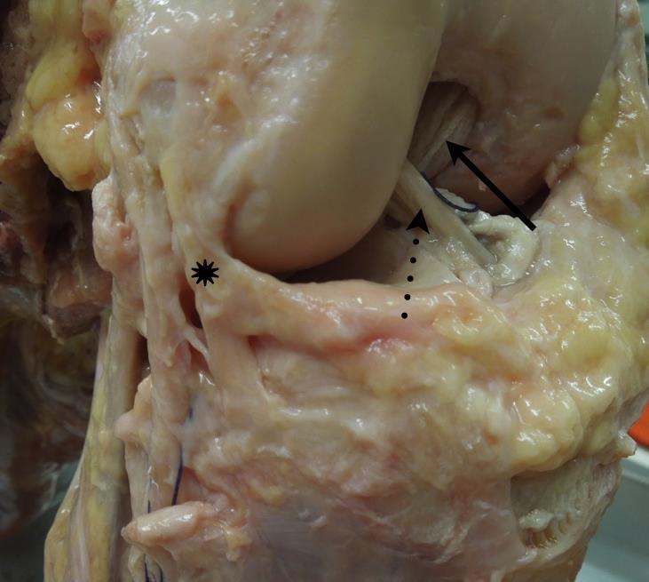 46 Figura 10 Foto anatômica de um joelho direito mostrando o ponto de bifurcação (asterisco) do ligamento anterolateral do joelho A porção tibial do LAL se insere na região anterolateral da tíbia,