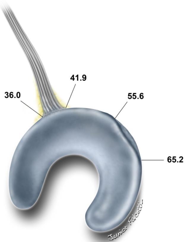 57 Figura 12 Desenho esquemático mostrando a inserção meniscal do ligamento anterolateral do joelho e sulco do tendão do músculo poplíteo em relação à superfície externa do menisco lateral 4.