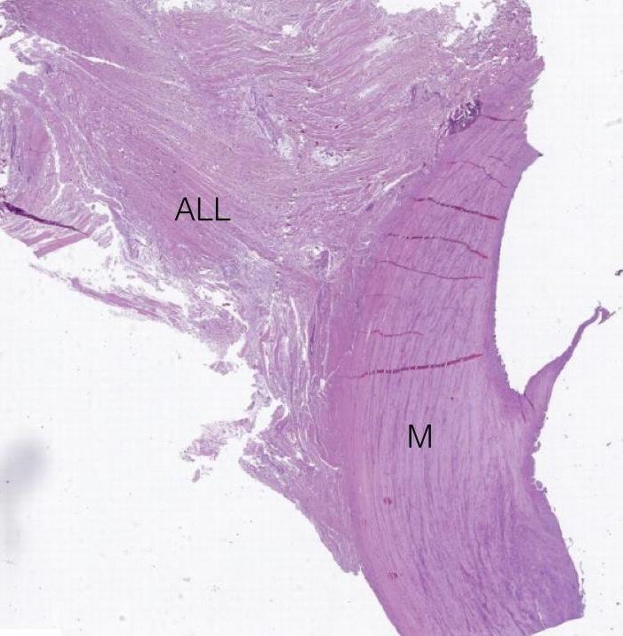 59 Figura 14 Imagem histológica mostrando o ligamento anterolateral (ALL) e sua inserção na periferia do menisco lateral (M).