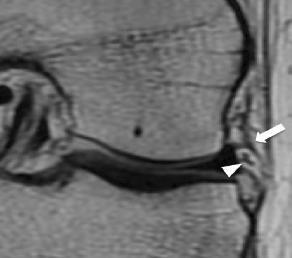 63 Figura 17 Imagem de ressonância magnética em corte coronal com sequência em densidade de prótons mostrando a artéria genicular inferior (cabeça de seta) lateral abaixo da bifurcação do ligamento