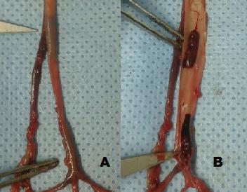 4 Figura 1 (A) áreas enegrecidas no lúmen da aorta; (B) Incisão