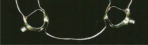 Os dentes de ancoragem são unidos por um arco lingual de Nance modificado pela extensão