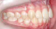 76 do sorriso ideal 21,23. Ao reanatomizar os dentes, é importante a aplicação do conceito da proporção estética, da proporção áurea e propriedades ópticas como translucidez e opalescência.