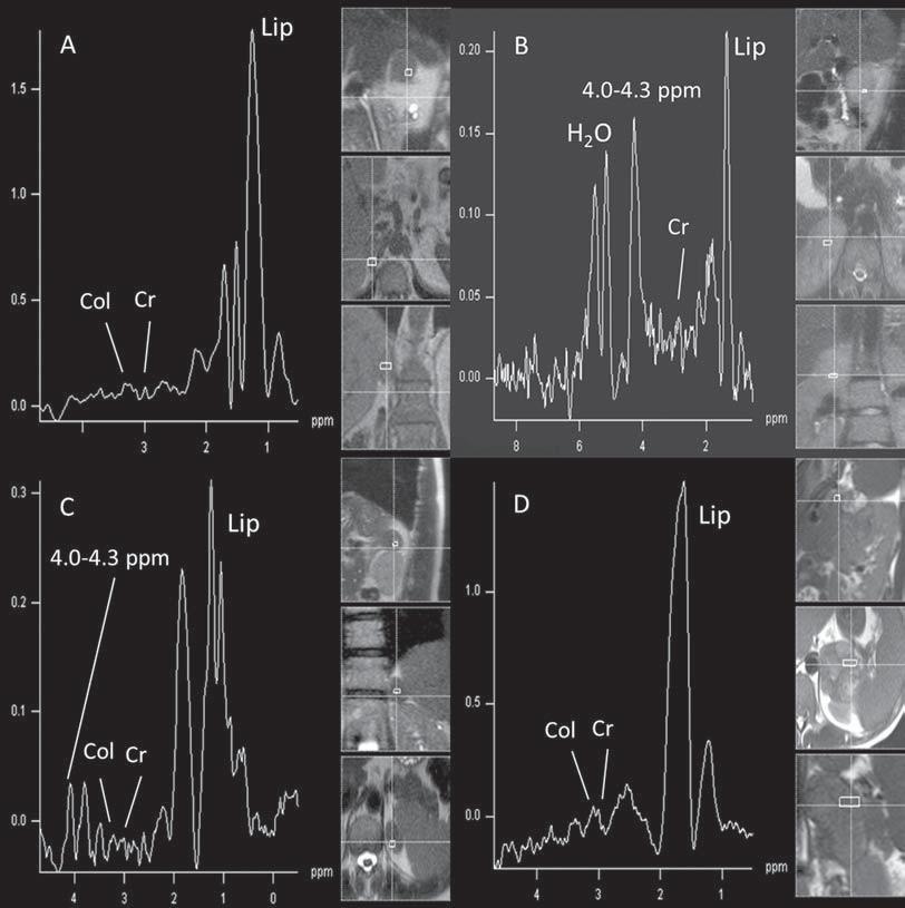 Figura 3. Gráficos espectroscópicos da adrenal em quatro diferentes massas: adenoma (A), feocromocitoma (B), carcinoma (C), metástase (D).