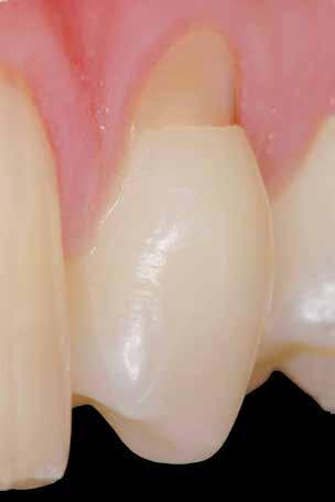 entre 30 a 60 anos; - Pacientes apresentando no mínimo 20 dentes em oclusão; - Pacientes apresentando no mínimo duas lesões cervicais não cariosas em pré-molares; - Pacientes apresentando LCNC em