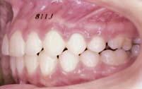 ortopédica aplicada na dentadura superior com ancoragem extrabucal).