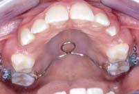 incisivos superiores, iniciada aos 10 anos e 6 meses, imediatamente após a exodontia dos primeiros pré-molares.