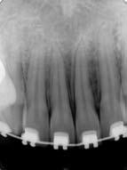 Para reforço de ancoragem, os segundos molares decíduos foram incluídos em um segmento de fio retangular passivo, que os unia aos primeiros molares permanentes.