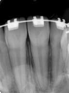 adaptados aos tubos auxiliares nos molares permanentes, sendo ativados para intruir os incisivos, com uma força de 15cN por elemento dentário (Fig. 11, ).