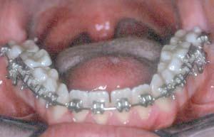 No caso deste paciente, imediatamente após o início da mecânica no arco inferior, os primeiros molares permanentes superiores foram bandados e uma barra transpalatina ativa para expansão foi adaptada.