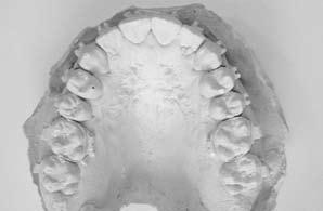 Uma expansão ortopédica ou cirúrgica do arco superior estaria contra-indicada, uma vez que não se observava uma atresia esquelética da maxila, com forma do arco adequada para um indivíduo
