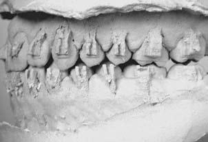 no pós-operatório. pós a fase de preparo, especialmente nos pacientes portadores de Padrão Face Longa lasse III, a relação transversal dos arcos dentários parece insatisfatória.