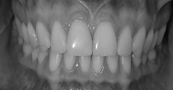 periodonto Destruição periodonto Higiene