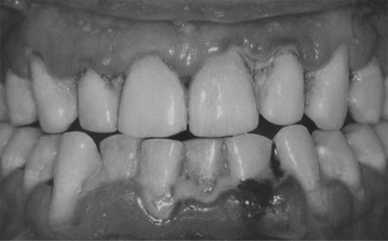 periodontal Prótese Ecologia Restauração
