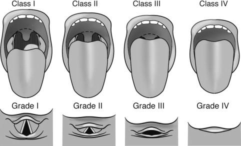 Classificação de Mallampati Classe I II III IV Condições Visível palato mole, pilares, úvulas e tonsilas palatinas anterior e