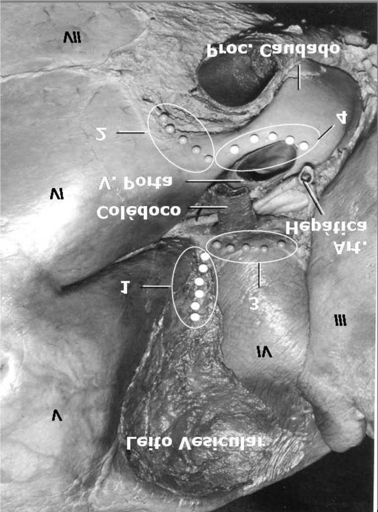 A incisão posterior pode, por vezes, ocasionar um sangramento maior, como resultado da secção de pequenas veias hepáticas. Esse sangramento, em geral, cessa espontaneamente.