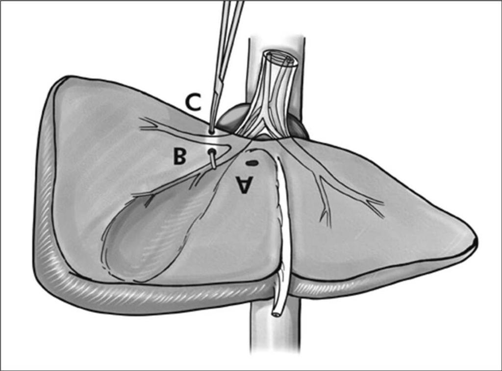 Para operações no fígado esquerdo a abordagem descrita acima pode ser utilizada, no entanto, a bainha esquerda pode ser isolada sem a necessidade do acesso posterior, apenas afastando-se a base do