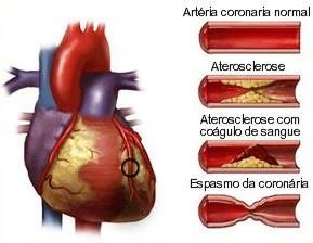 Doença arterial coronariana: placas ateroscleróticas (depósito de gordura, colesterol) nas coronárias, que