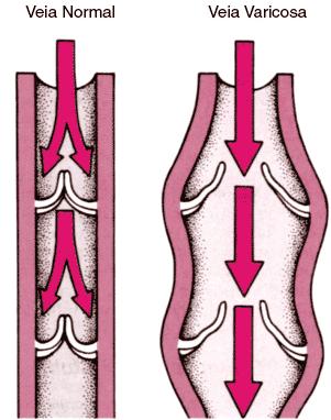 Acidente vascular cerebral (AVC): distúrbio na circulação cerebral (isquemia ou