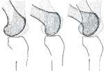 115 Movimentos dos Côndilos sobre as Glenas Nos movimentos de flexão-extensão, associam-se o rolamento e o deslizamento. Na flexão: Sob a ação dos flexores, os côndilos rolam.