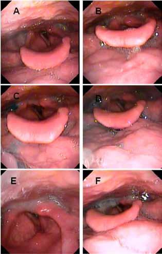 todas as consistências de alimentos; A e B: estase salivar moderada na valécula e seios piriformes; C e D: contenção oral insuficiente; E e F: redução da sensibilidade laríngea com penetração, mas