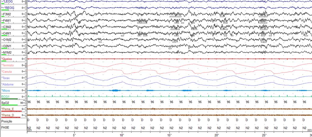 Introdução 5 A polissonografia (PSG) é o exame de escolha para o diagnóstico dos distúrbios do sono e consiste no registro simultâneo de variáveis fisiológicas que incluem (recomendado):