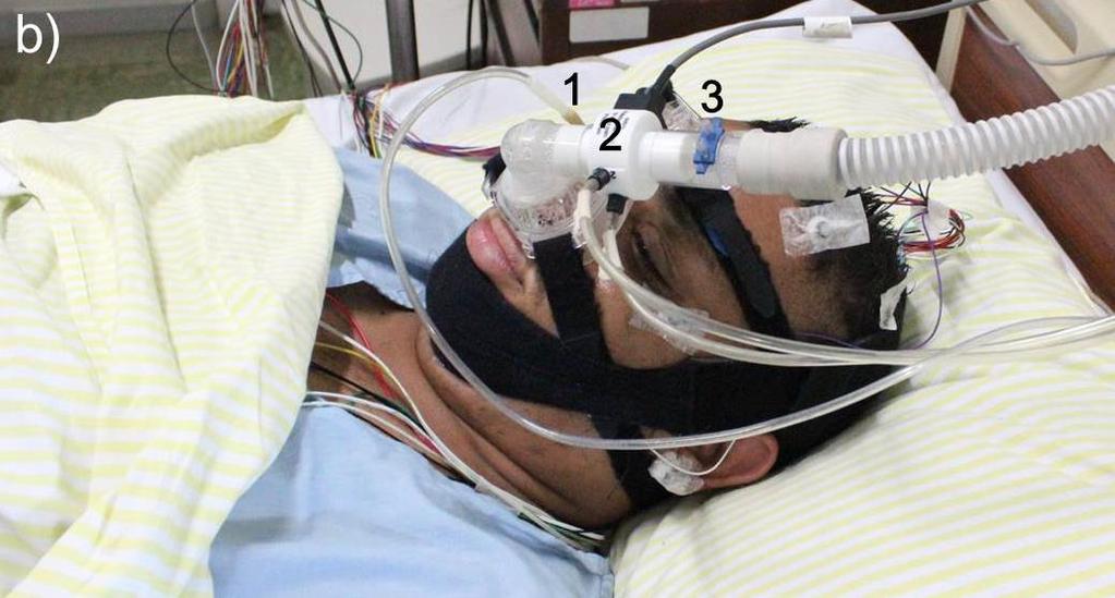 b) Paciente preparado para a determinação da Pcrit, dormindo em decúbito dorsal, utilizando CPAP modificado e máscara