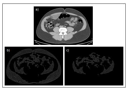 Métodos 44 segundos. A gordura visceral e subcutânea foi medida ao nível da cicatriz umbilical, englobando dois cortes transversais.