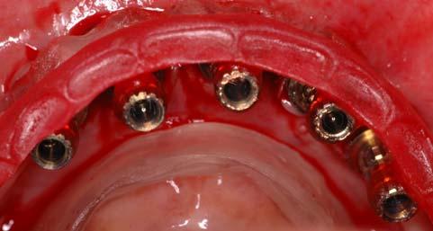 dentes de acordo com a mordida registrada pelo articulador na montagem dos dentes superiores e