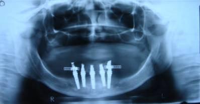 Material e Métodos Figura 16 - Raio X panorâmico após 24 meses da colocação dos implantes e da prótese.