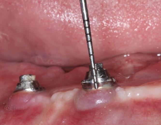 43 5.8.1.5 Avaliação do nível da margem da mucosa Foi avaliada a distância entre a mucosa periimplantar e a cinta do mini pilar, medida em milimetros através de sonda periodontal Willians.
