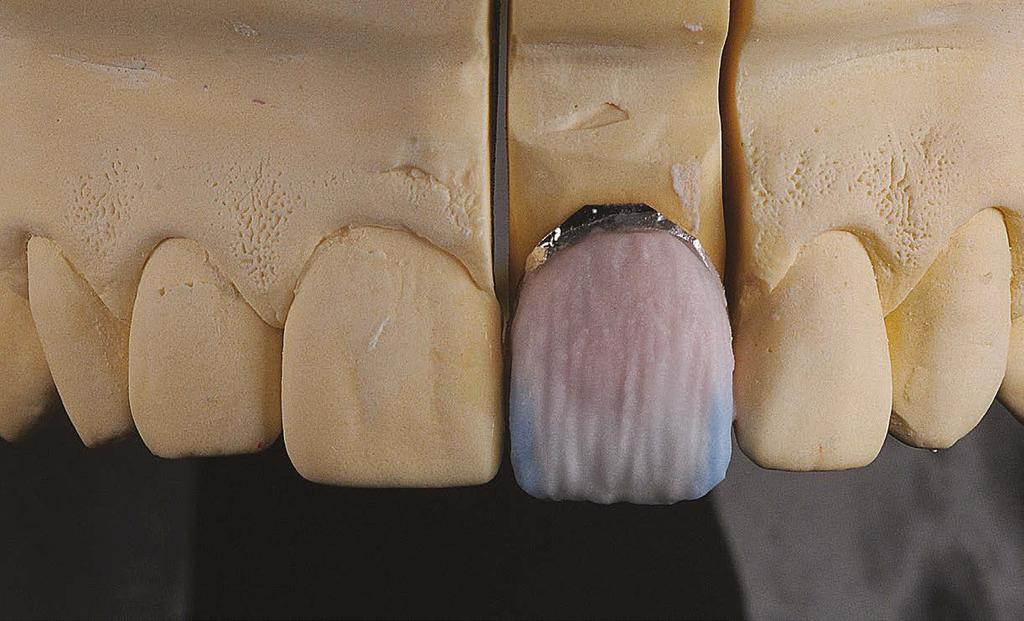 (A) Estratificação das camadas de cerâmica, aplicação de uma camada fina de dentina B1 (Creation CC); (B) reprodução