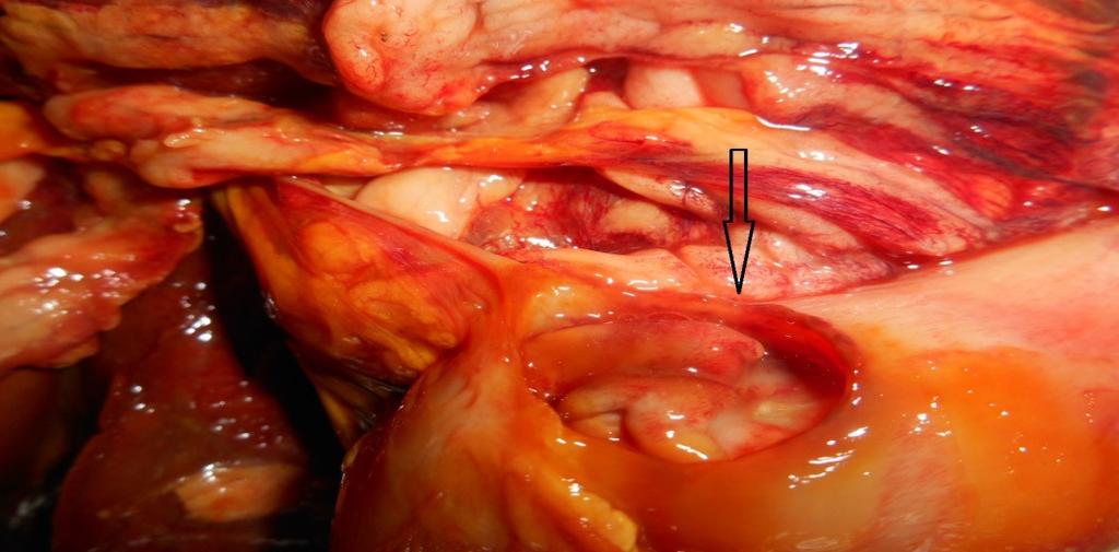 61 Figura 2- Fotografia da região de transição gastroduodenal cão. Úlcera perfurada de aproximadamente 2 cm de diâmetro, permitindo a visualização da mucosa gástrica.