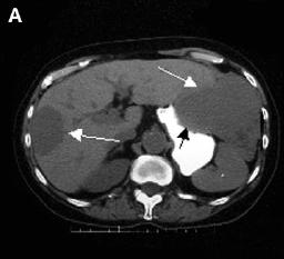 CT sem