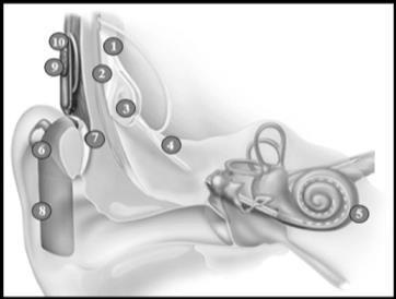 24 Figura 1 - Componentes dos dispositivos interno e externo do implante coclear. Fonte: Adaptado de Cochlear Corporation. How does a cochlear 