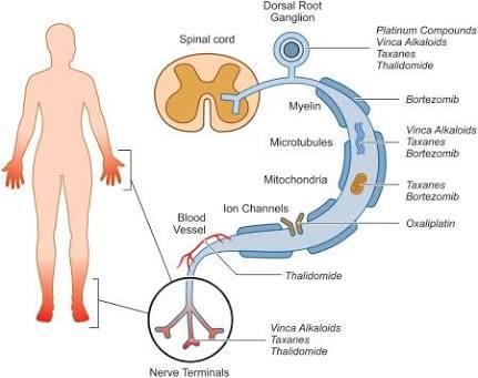 Google image NPIQ: fisiopatologia São multifatoriais e envolvem: degeneração axônica estresse oxidativo mecanismos apoptóticos alterações na homeostase do cálcio remodelação de membrana processos