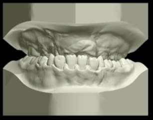 2 Revisão de Literatura 43 Figura 4: Modelos virtuais da oclusão anterior de um paciente com fissura bilateral, ilustrando mordida cruzada anterior e posterior. 2.