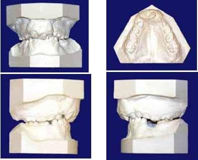 2 Revisão de Literatura 49 Fonte: (http://www.acpacpf.org/research/americleftstudyguide.pdf). Acesso em:1nov.2012. Figura 5: Índice oclusal 1.