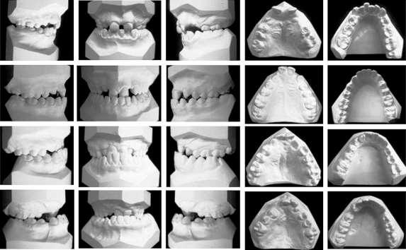 58 2 Revisão de Literatura Fonte: Ozawa et al., 2011 Figura 12: Índice oclusal bilateral dos 12 anos de idade: Escores 1+ 2, 3, 4 e 5. O mesmo índice foi utilizado por Bartzela et al.