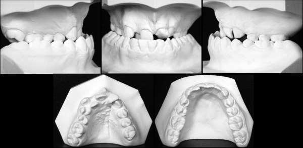 2 Revisão de Literatura 61 Fonte: DOGAN et al., 2012. Figura 13: Imagens 2D obtidas de modelos de gesso. Chawla et al.(2011), aplicando o índice de Atack et al.