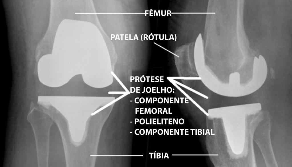 Após a cirurgia, você será encaminhado à Unidade de Recuperação Pós-Anestésica, onde receberá medicações para dor e orientações sobre exercícios respiratórios, importantes para prevenir complicações