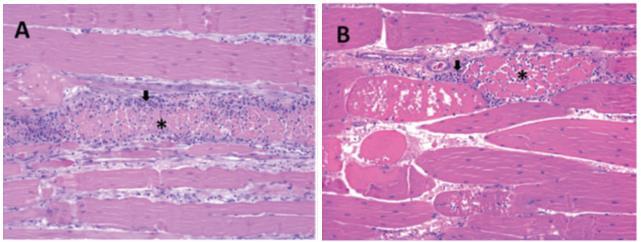 25 Figura 11 Fotomicrografia do músculo Pectoralis major de frango de corte acometido com WS. A) Grau severo com necrose grave da fibra muscular (asterisco).