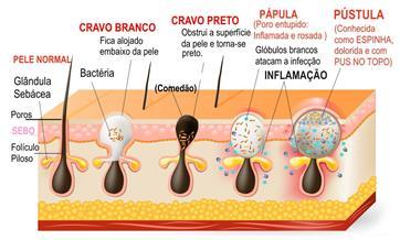 erupções da pele com lesões não inflamatórias como comedões, e inflamatórias como as pústulas e os nódulos.