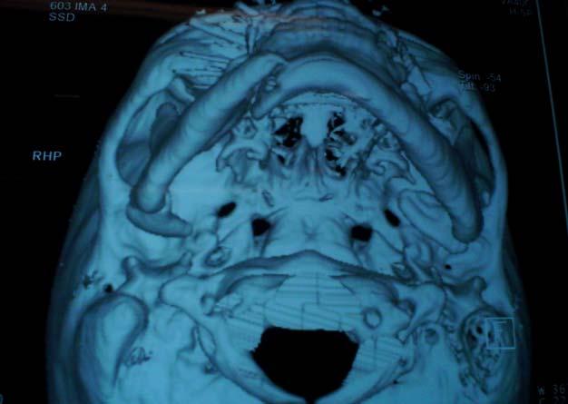 à incisura mandibular ou logo a baixo da mesma. Os desvios diagnosticados pelas tomografias, dividiram-se em mediais (Figura 1) e laterais.