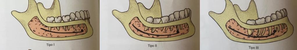 Tipo 3: O canal mandibular localiza-se próximo aos ápices dos molares e do segundo pré-molar, em casos de corpo mandibular baixo.