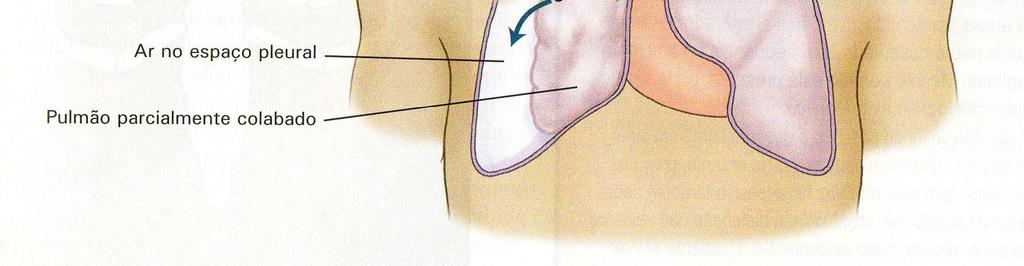 para fora da cavidadetorácicapela lesãoda parede=