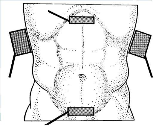 penetrante do tórax Tríade Beck (achados clássicos): turgência jugular,